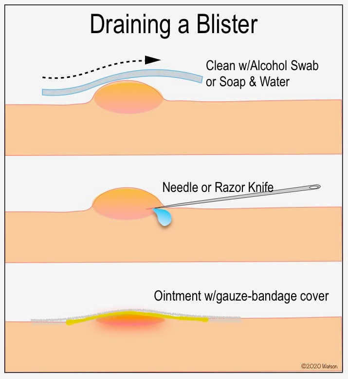 ILLUST-BLISTER DRAINING